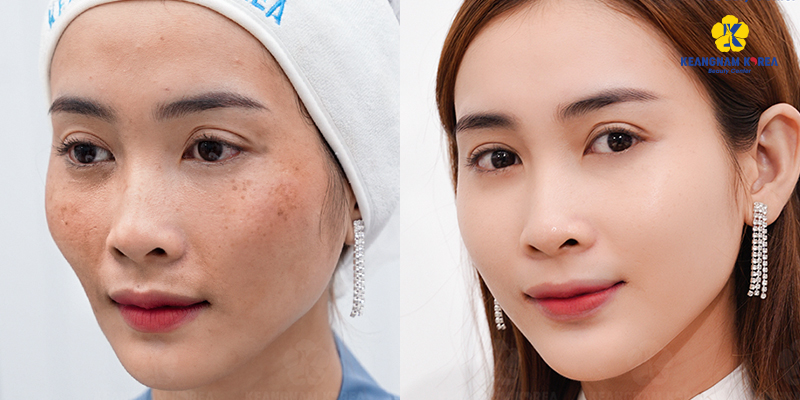 Exosome mesotherapy: Comprehensive Guide to Skin Rejuvenation, Ideal Candidates, and Recovery Timeline 4 Exosome mesotherapy 3