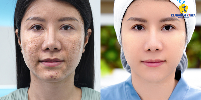Exosome mesotherapy: Comprehensive Guide to Skin Rejuvenation, Ideal Candidates, and Recovery Timeline 5 Who Is the Ideal Candidate for Exosome Mesotherapy?