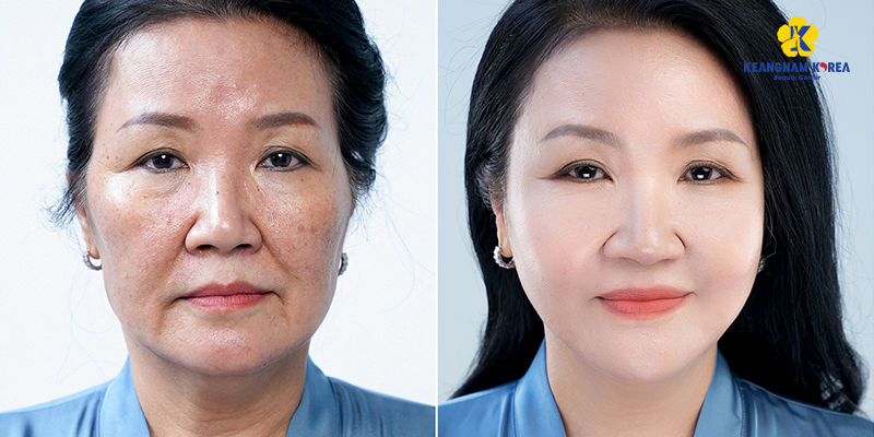 Anti-Aging Skin Treatment Guide: The Best Methods for Asian Skin and 2026 Cost 5 anti-aging skin treatment