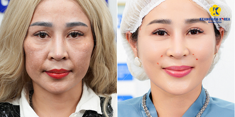 PRP vs. Mesotherapy Skin: Which Skin Rejuvenation Is Better? 5 PRP vs. Mesotherapy Skin