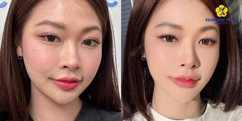 PRP vs. Mesotherapy Skin: Which Skin Rejuvenation Is Better? 3 PRP vs. Mesotherapy Skin