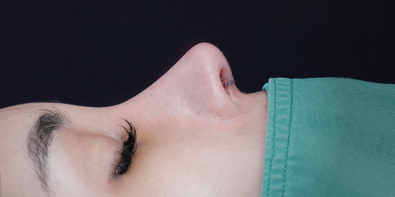 Rhinoplasty Aftercare: Recovery Guide on Foods, Sleep & Healing Timeline 1 rhinoplasty swelling timeline