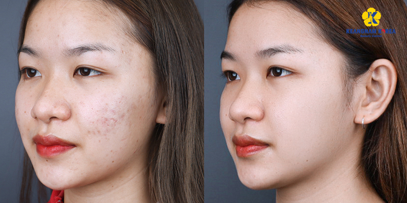 Acne Scar Treatment With Mesotherapy: How Many Sessions Until Smooth Skin? 2 Acne Scar Treatment With Mesotherapy