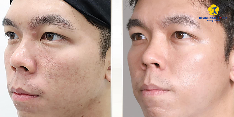 Acne Scar Treatment With Mesotherapy: How Many Sessions Until Smooth Skin? 3 Acne Scar Treatment With Mesotherapy