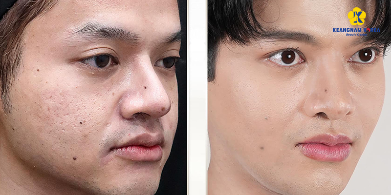 Acne Scar Treatment With Mesotherapy: How Many Sessions Until Smooth Skin? 6 Acne Scar Treatment With Mesotherapy