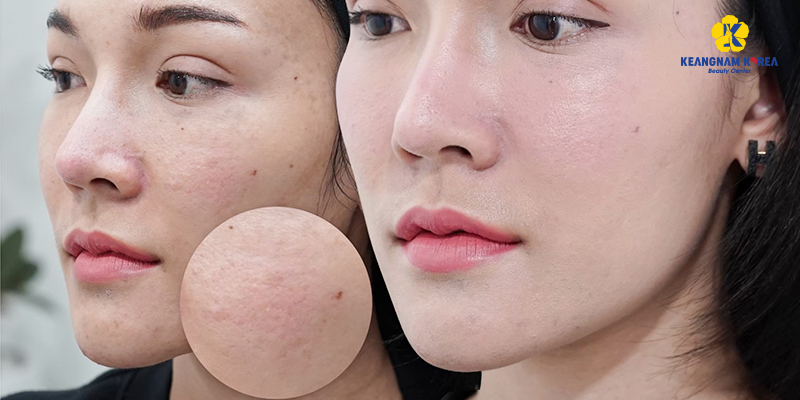 Acne Scar Treatment With Mesotherapy: How Many Sessions Until Smooth Skin? 7 Acne Scar Treatment With Mesotherapy