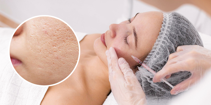 Acne Scar Treatment With Mesotherapy: How Many Sessions Until Smooth Skin? 1 Acne Scar Treatment With Mesotherapy