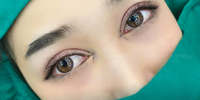 Epicanthoplasty Scar: Causes, Prevention & Effective Treatments to Restore Flawless Eyes 4 epicanthoplasty scar before and after