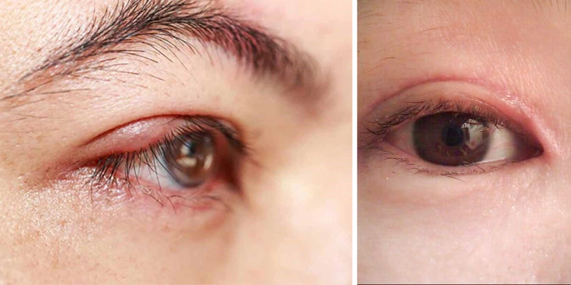 Epicanthoplasty Scar: Causes, Prevention & Effective Treatments to Restore Flawless Eyes 1 epicanthoplasty scar