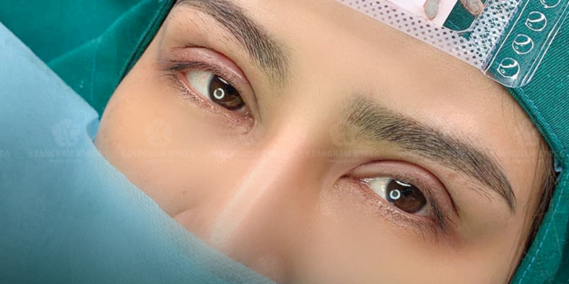 Lateral Canthoplasty for Slanted Eyes: Is It Worth It & Where to Get It Done in Ho Chi Minh City, Vietnam? 2 Ideal Candidates for Lateral Canthoplasty