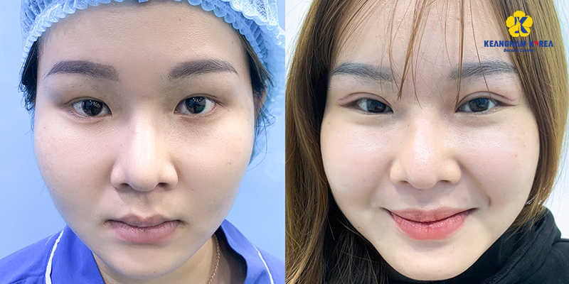 Lateral Canthoplasty for Slanted Eyes: Is It Worth It & Where to Get It Done in Ho Chi Minh City, Vietnam? 4 Lateral Canthoplasty for Slanted Eyes