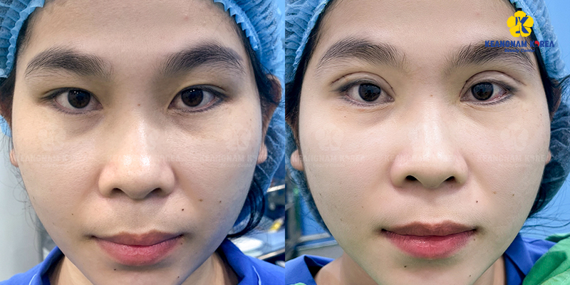 Lateral Canthoplasty for Slanted Eyes: Is It Worth It & Where to Get It Done in Ho Chi Minh City, Vietnam? 5 Lateral Canthoplasty for Slanted Eyes