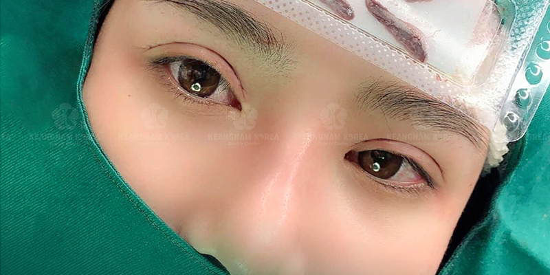 Lateral Canthoplasty for Slanted Eyes: Is It Worth It & Where to Get It Done in Ho Chi Minh City, Vietnam? 6 Lateral Canthoplasty for Slanted Eyes