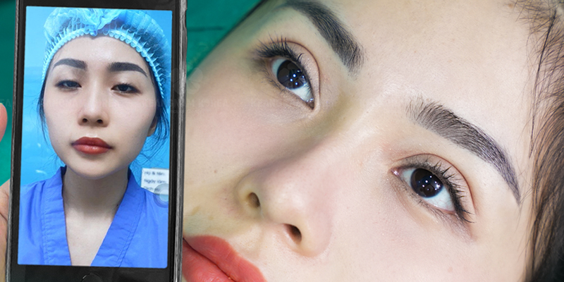 What Is Outer Corner Eye Surgery? Types, Cost, and Results 3 outer corner eye surgery