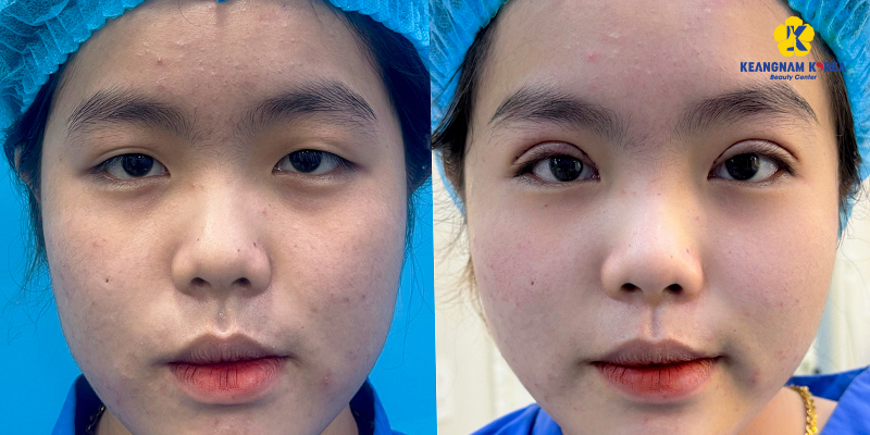 What Is Outer Corner Eye Surgery? Types, Cost, and Results 5 outer corner eye surgery