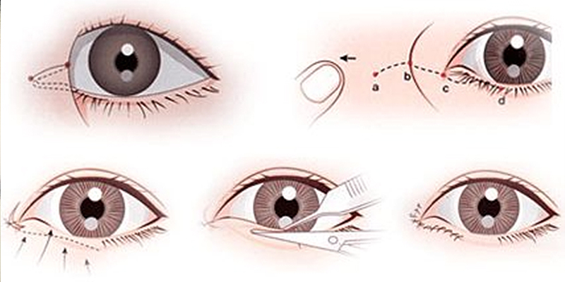 What Is Outer Corner Eye Surgery? Types, Cost, and Results 1 outer corner eye surgery