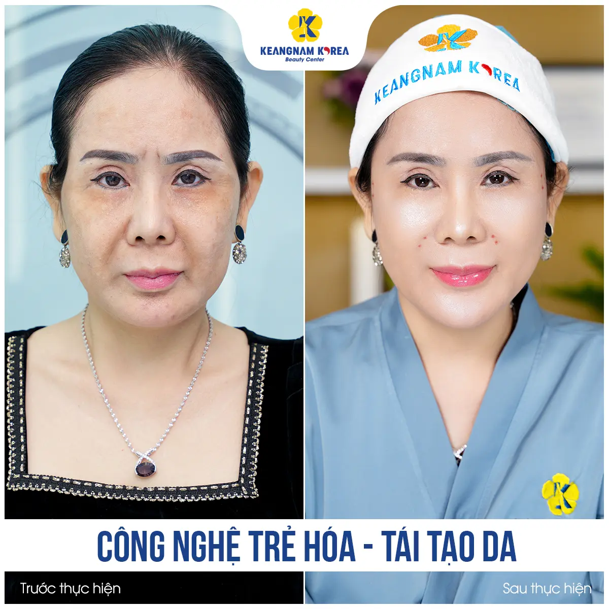 Khách hàng thực hiện thành công xoá nếp nhăn tại Keangnam Korea 4