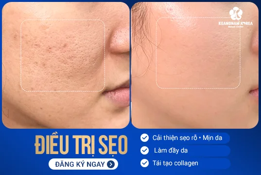 GG ADS Dieu tri seo