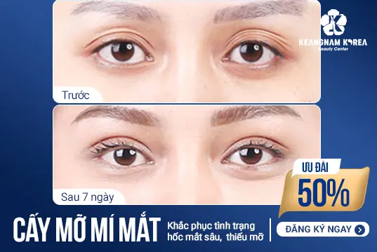 Cấy mỡ mí mắt