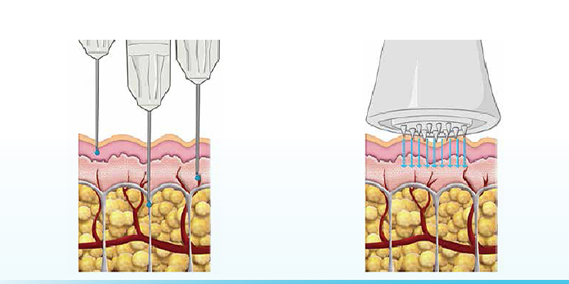 Mesotherapy là gì?