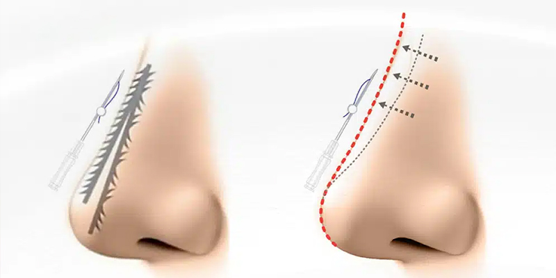 Nâng mũi chỉ có an toàn không