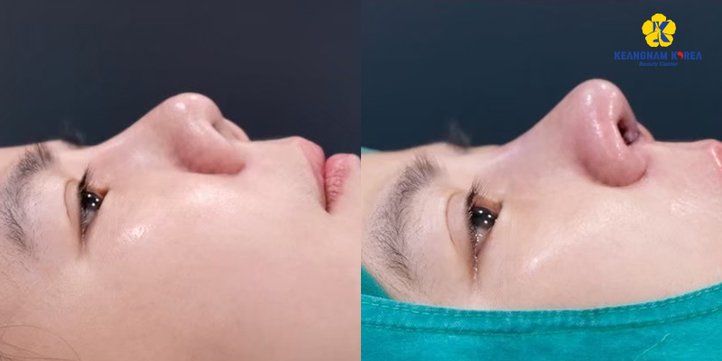 Is Rhinoplasty Dangerous? Who Should & Shouldn't Get Nose Plastic Surgery 4 is rhinoplasty dangerous