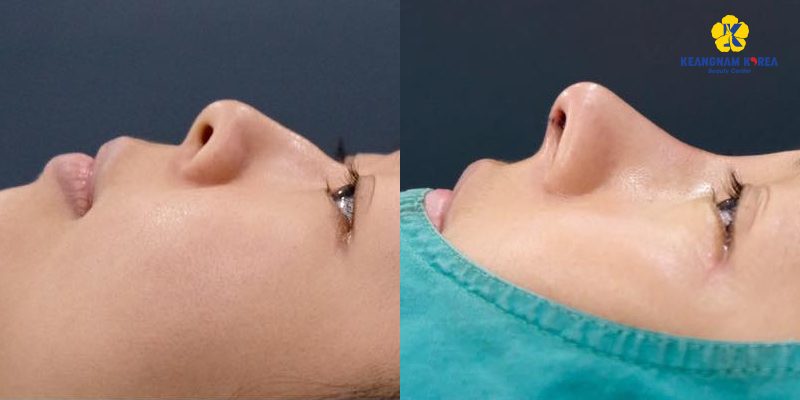 Is Rhinoplasty Dangerous? Who Should & Shouldn't Get Nose Plastic Surgery 5 is rhinoplasty dangerous