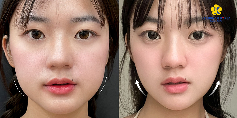 3 Non-Surgical Jaw Reduction Methods to Sculpt a V-Line at Keangnam Korea 6 Non-Surgical jaw reduction