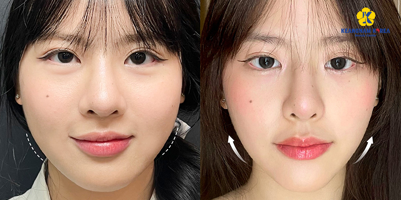 3 Non-Surgical Jaw Reduction Methods to Sculpt a V-Line at Keangnam Korea 7 Non-Surgical jaw reduction