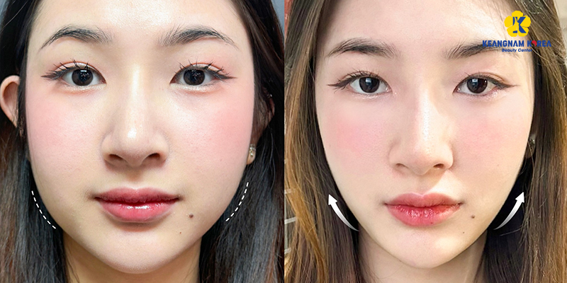 3 Non-Surgical Jaw Reduction Methods to Sculpt a V-Line at Keangnam Korea 8 Non-Surgical jaw reduction