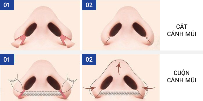 Phân biệt kỹ thuật cuộn cánh mũi và cắt cánh mũi