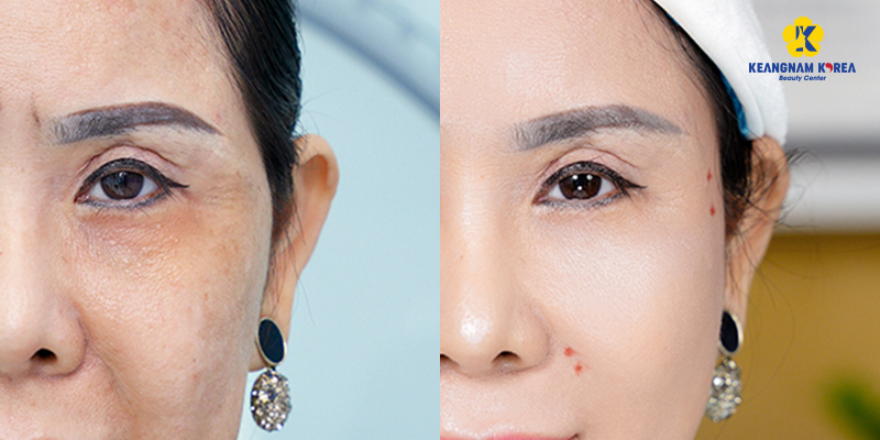 Temporal Lift: What It Is, Cost, Scars & the Fox-Eye Effect 2 Temporal Lift