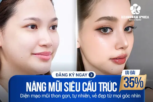 Nâng mũi siêu cấu trúc