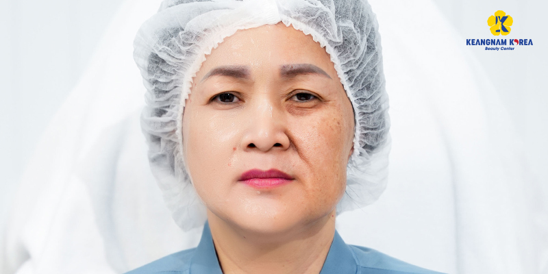 Top 4 High-Tech Options for Skin Rejuvenation Treatment in Vietnam 2 Non Invasive skin Rejuvenation