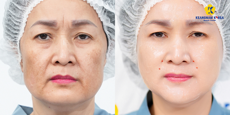Top 4 High-Tech Options for Skin Rejuvenation Treatment in Vietnam 3 Non Invasive Facial Rejuvenation
