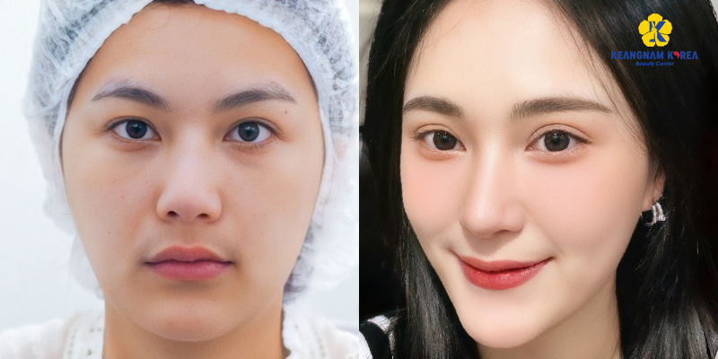 Cosmetic Eye Surgery Cost in Vietnam 2026 6 Cosmetic Eye Surgery Cost in Vietnam 2026