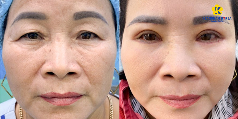 Cosmetic Eye Surgery Cost in Vietnam 2026 3 Cosmetic Eye Surgery Cost in Vietnam 2026