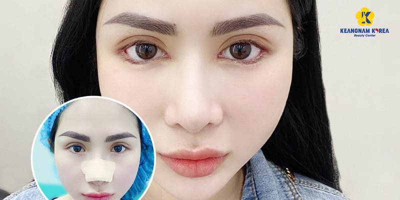 Cosmetic Eye Surgery Cost in Vietnam 2026 5 Cosmetic Eye Surgery Cost in Vietnam 2026