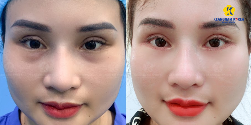 Cosmetic Eye Surgery Cost in Vietnam 2026 4 Cosmetic Eye Surgery Cost in Vietnam 2026