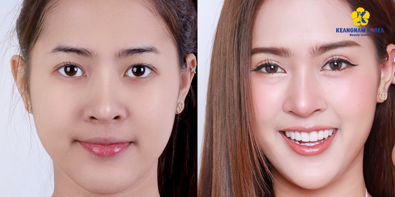 Eye Lift VS Cold Plasma Blepharoplasty: Surgical Techniques, Recovery, and Costs 2 Eye Lift VS Cold Plasma Blepharoplasty