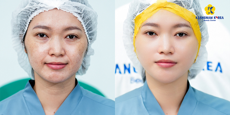Mesotherapy Machine vs. Manual Injection: Which Is Safer and More Effective? 4 Mesotherapy Machine vs. Manual injection