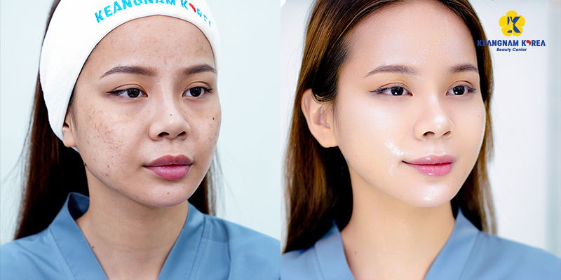 Mesotherapy Machine vs. Manual Injection: Which Is Safer and More Effective? 5 Mesotherapy Machine vs. Manual