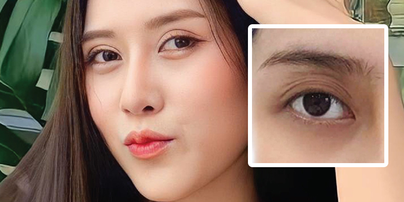 Sunken Eyes Treatment: Causes, Severity Levels & Best Solutions to Restore a Youthful Look 4 Sunken Eyes Treatment