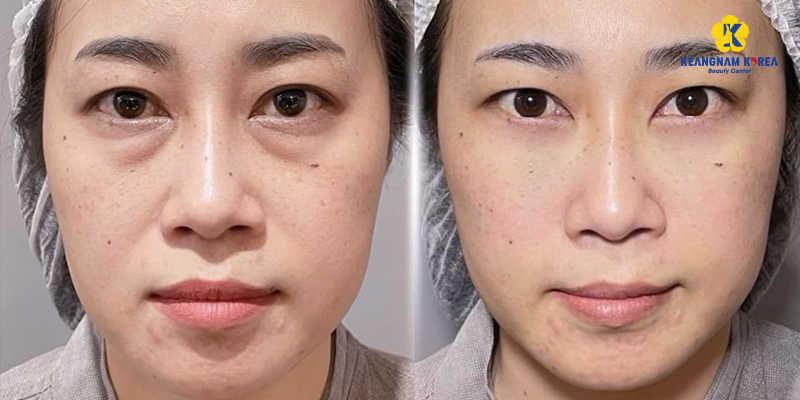 How Much Does Double Eyelid Surgery Cost in Ho Chi Minh City? 2026 Asian Blepharoplasty Price List at Keangnam Korea 4 asian blepharoplasty cost