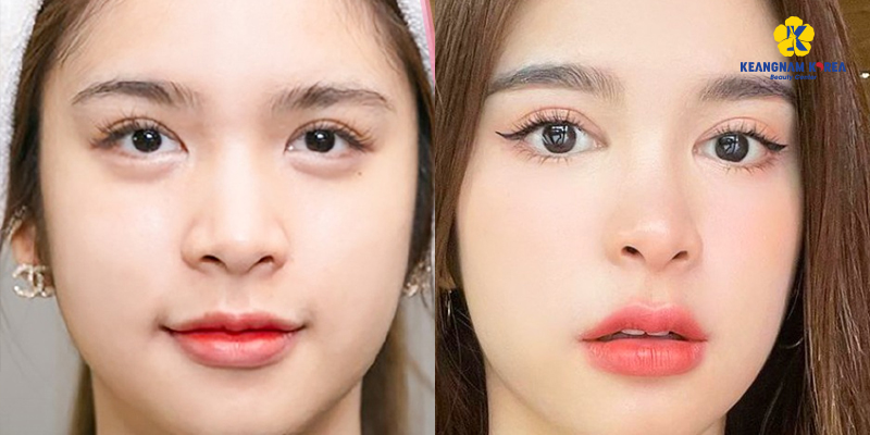 How Much Does Double Eyelid Surgery Cost in Ho Chi Minh City? 2026 Asian Blepharoplasty Price List at Keangnam Korea 6 double eyelid surgery Ho Chi Minh
