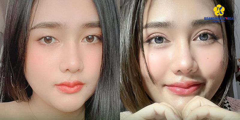 How Much Does Double Eyelid Surgery Cost in Ho Chi Minh City? 2026 Asian Blepharoplasty Price List at Keangnam Korea 5 double eyelid surgery price 2026