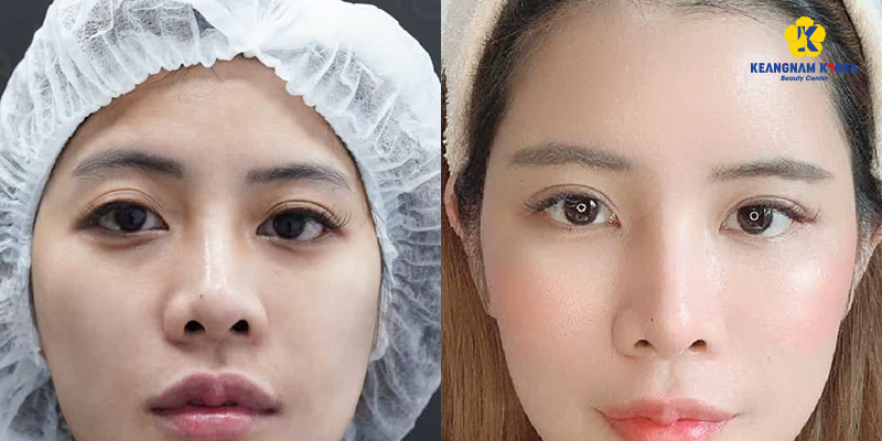 How Much Does Eye Fat Grafting Cost in Ho Chi Minh City? 2026 Updated Prices 5 fat grafting for hollow eyes
