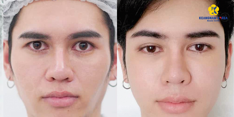 How Much Does Eye Fat Grafting Cost in Ho Chi Minh City? 2026 Updated Prices 6 fat grafting for under eye hollows