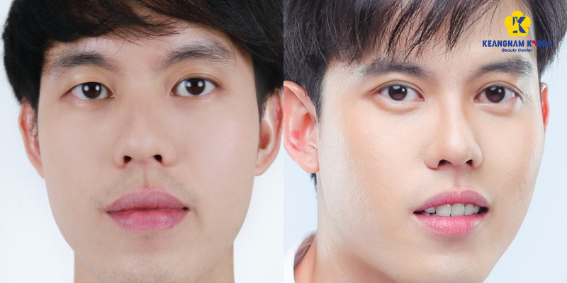 Asymmetrical Eye Surgery Cost: Cause, Method, Cost and Treatment Guide 3 asymmetric eye correction cost 1