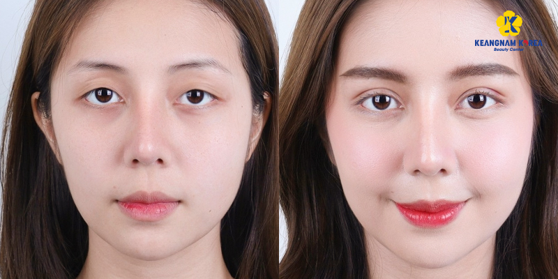 Asymmetrical Eye Surgery Cost: Cause, Method, Cost and Treatment Guide 5 asymmetric eye correction cost 5